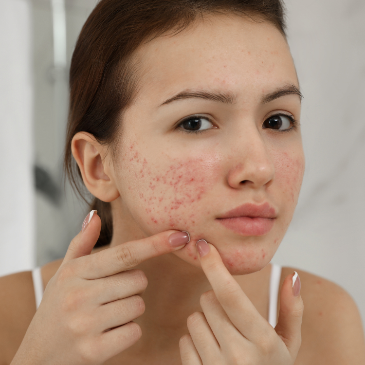 Acne: Causes, Treatments, and Prevention