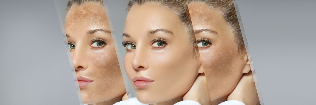 Skincare tips to treat pigmentation and scarring